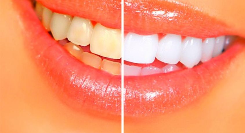 Белоснежная улыбка теперь доступна всем! Скидка 50% на косметическое отбеливание зубов от студии  «Smileffect33».