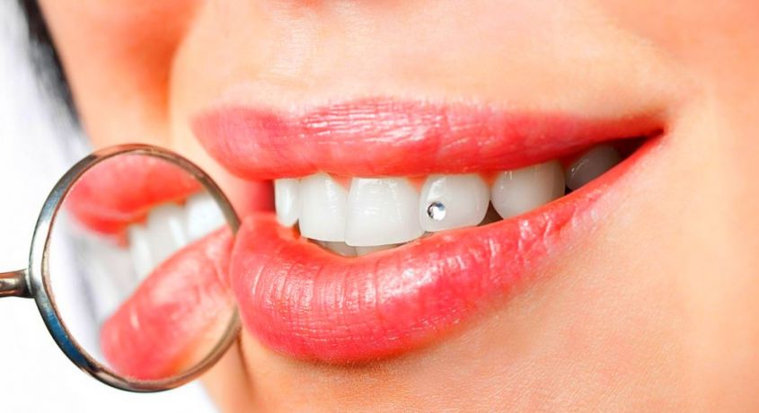 Опытный стоматолог клиники «Здравия» укрепит ваши зубки с помощью специальных оздоравливающих масок или поставит стразу.
