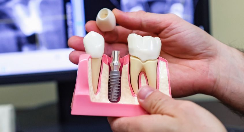 Имплантация зубов на системе BIOMED (Швейцария) под ключ от сети медицинских клиник Здравия во Владимире!