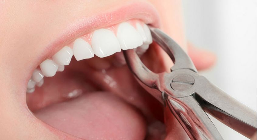Избавься от боли! Скидка 50% на удаление зуба мудрости или на сложное удаление любого зуба от Стоматологии «110».