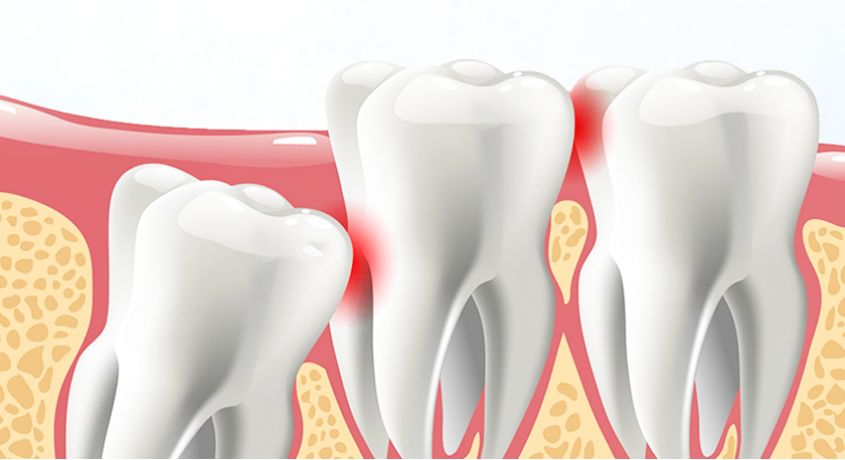 Избавься от боли! Скидка 50% на удаление зуба мудрости или на сложное удаление любого зуба от Стоматологии «110».