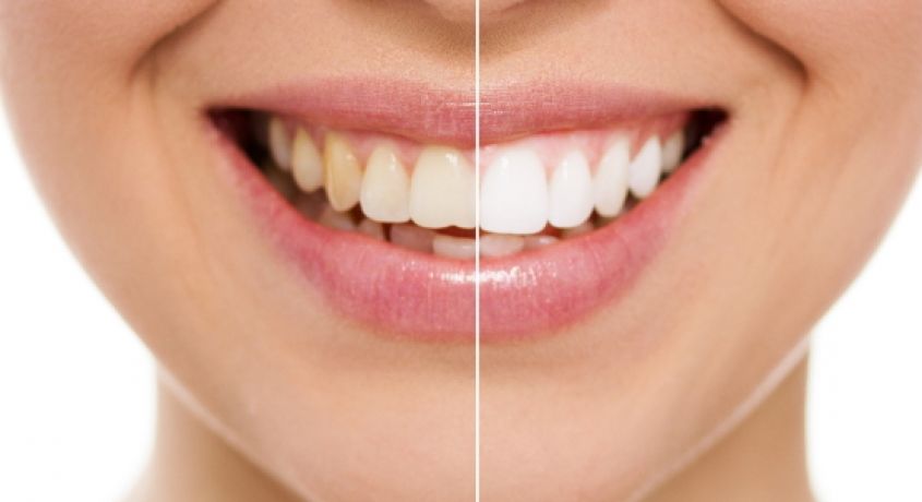 Скидка 70% на профессиональную чистку зубов ультразвуком и отбеливание Air Flow в стоматологической клинике «Стоматология 33»!