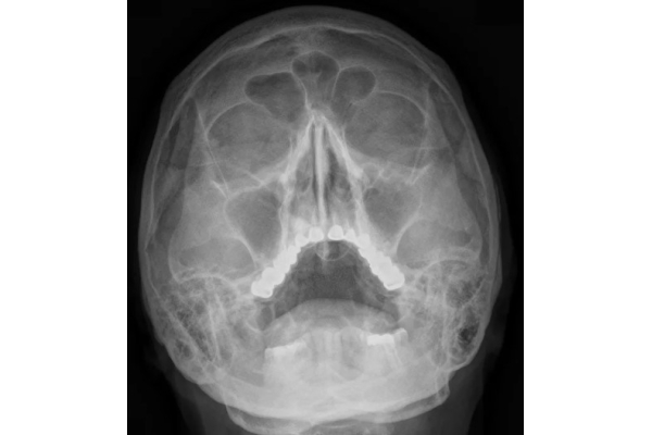 Рентгенография лобной пазухи