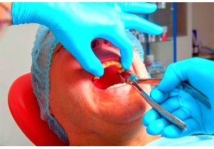 Удаление многокоренного зуба (простое)