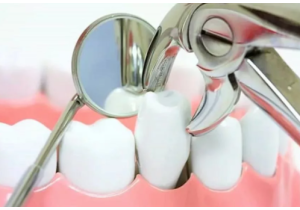 Удаление многокорневого зуба (2 степень сложности)