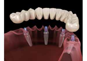 Имплантация зубов одномоментно