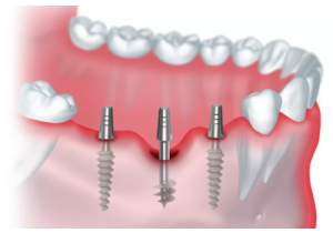 Базальная имплантация зубов под ключ