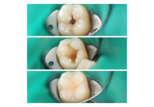 Реставрация жевательных зубов