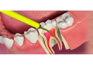 Лечение пульпита постоянного зуба (4 канала) + полная реставрация