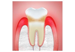 Лечение периодонтита постоянного зуба (2 канала)+ частичная реставрация