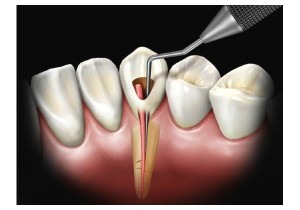 Лечение периодонтита постоянного зуба (4 канала)+ полная реставрация