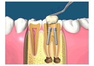 Лечение периодонтита постоянного зуба (4 канала)+ частичная реставрация