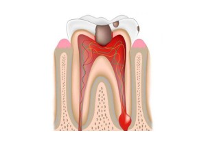 Лечение периодонтита 1 корневого зуба