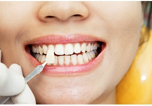 Реставрация зуба при утрате от 20% ткани