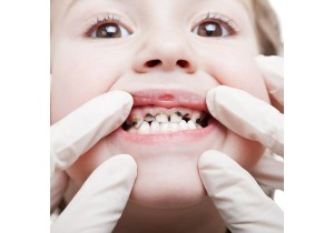 Лечение кариеса у детей постоянный зуб
