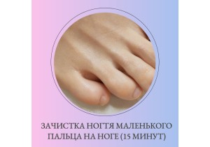 Зачистка ногтя маленького пальца на ноге