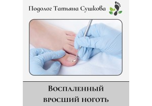 Коррекция вросшего воспаленного ногтя