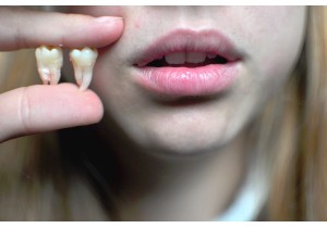 Удаление многокорневого зуба 