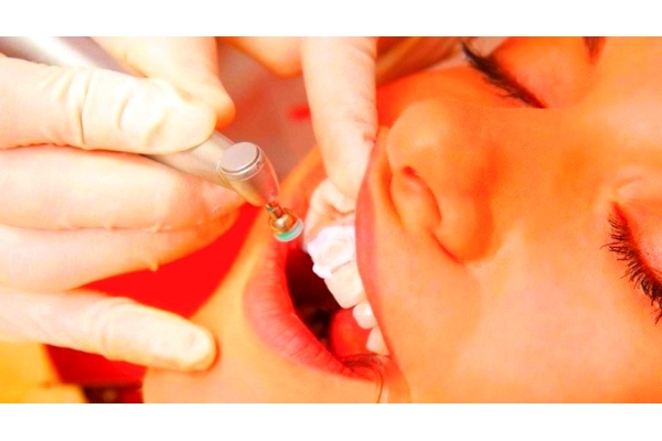 Снятие зубных отложений (1 зуб)