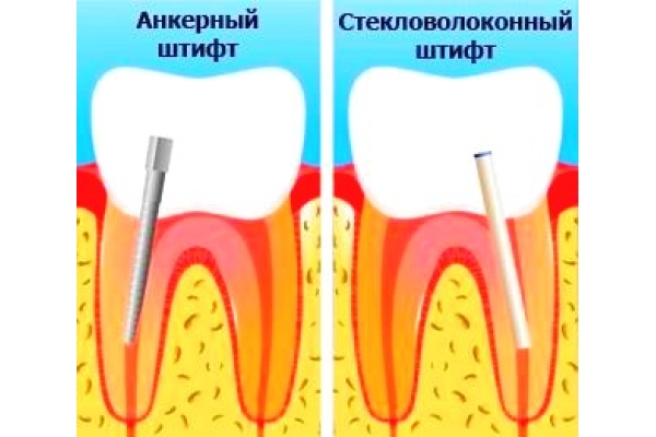 Восстановление зуба при помощи стекловолоконного штифта