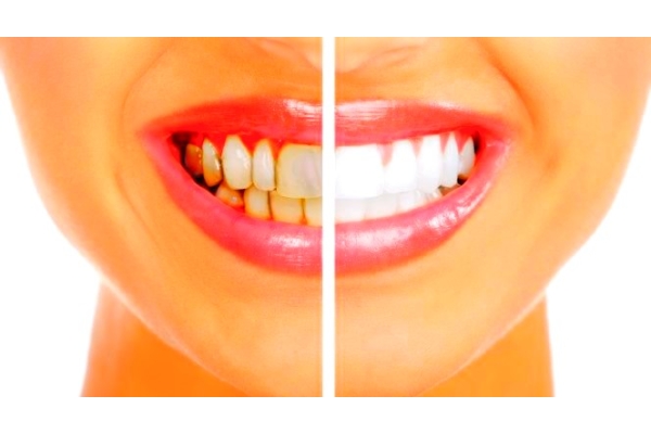 Удаление зубных отложений ультразвуком (обе челюсти)