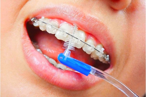 Профессиональная гигиена зубов одной челюсти с последующей шлифовкой и полировкой при брекет-системах