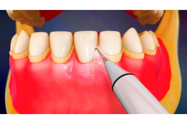 Удаление наддесневых зубных отложений с 1 зуба ультразвуковым скейлером