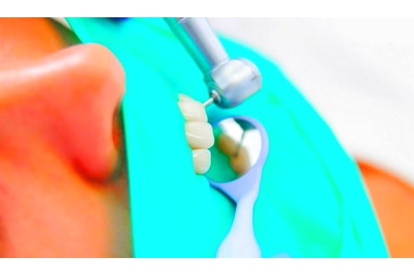 Реставрация коронковой части зуба по поводу кариеса
