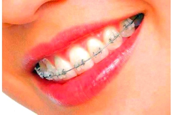 Самолигирующиеся брекеты «SmartClip» на 1 зубной ряд