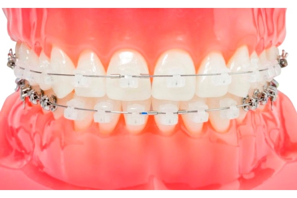 Лечение на самолигирующейся брекет системе (1 зубной ряд)