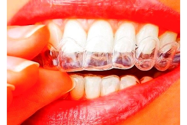 Лечение на одном зубном ряду до 5 капп