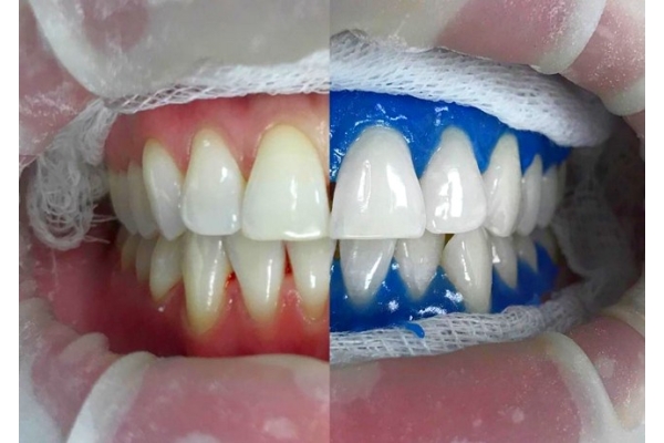 Нанесение на зуб отбеливающего препарата