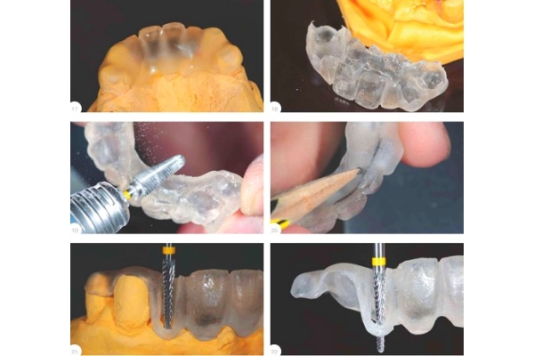 Хирургический шаблон на каждый последующий зуб