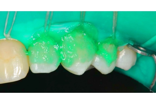 Инфильтрационный метод лечения кариеса ICON (передние зубы)