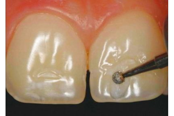Сошлифовывание твердых тканей зуба 