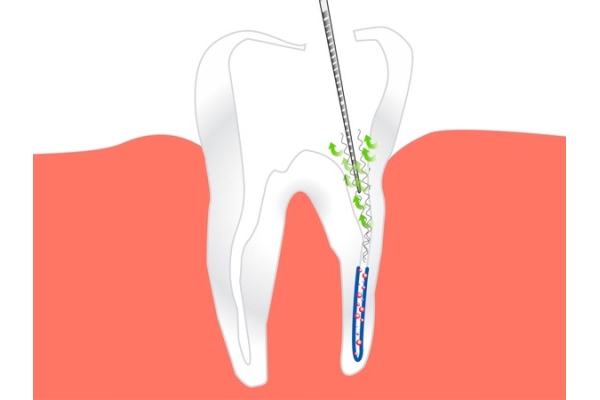 Ультразвуковая обработка корневого канала зуба