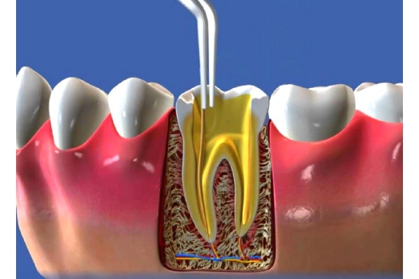 Трехмерное пломбирование корневого канала зуба (Gutta core)