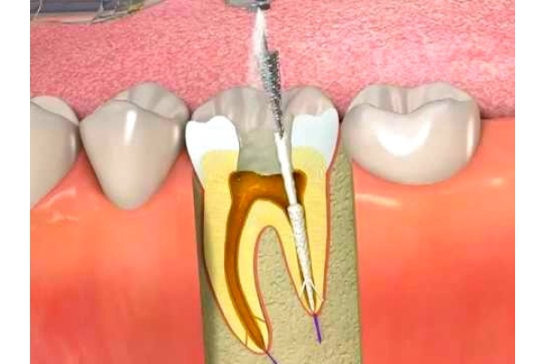 Ультразвуковое расширение корневого канала зуба (вкладка, фрагмент инструмента)