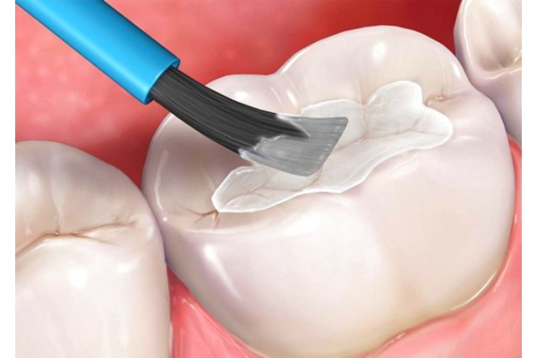 Глубокое фторирование (область 1 зуба)