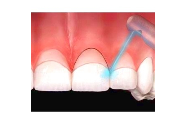 Гингивоэктомия 2 зуба