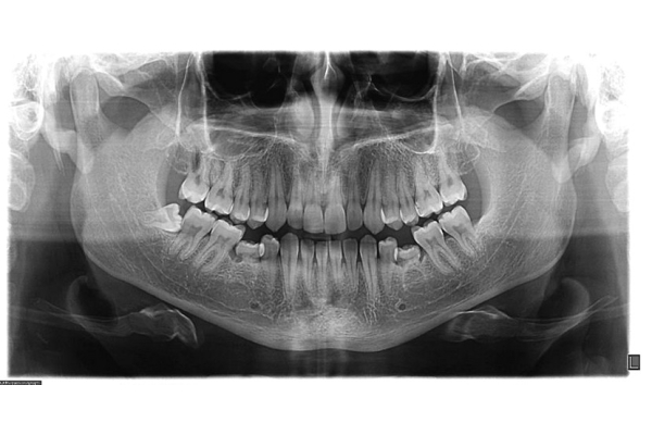 Ортопантомография (ОПГ) панорамный снимок верхней и нижней челюсти
