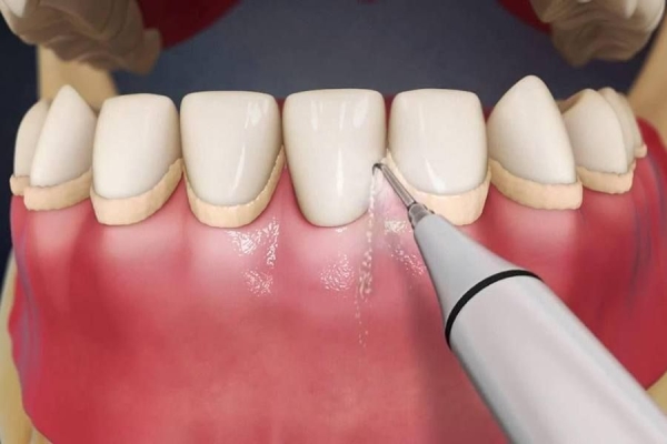 Снятие зубных отложений системой Air-flow