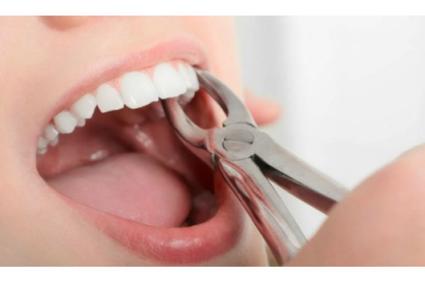 Удаление верхних зубов