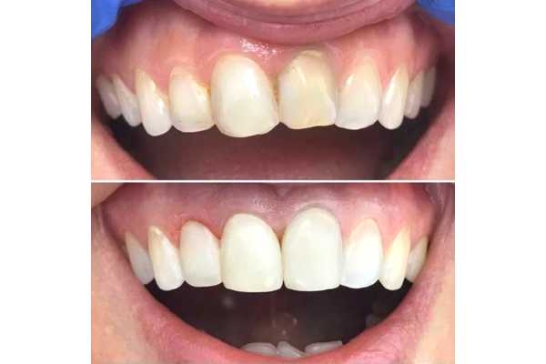 Реставрация трещин зуба