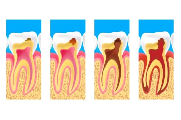 Лечение пульпита постоянного зуба (1 канал) + полная реставрация (1 посещение)