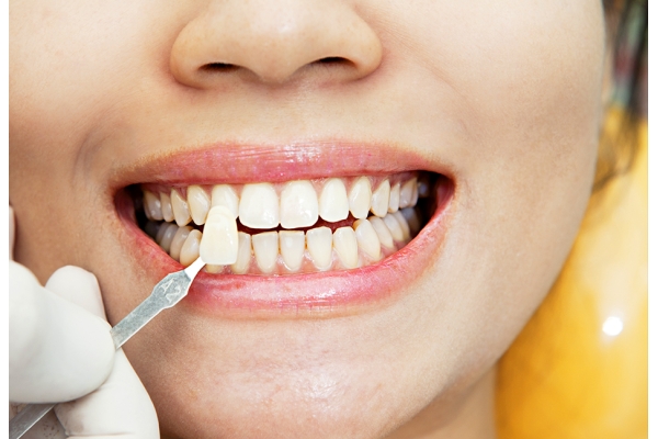 Реставрация зуба при утрате от 20% ткани