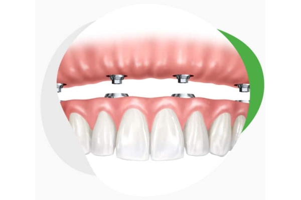 Покрывной зубной протез на имплантах