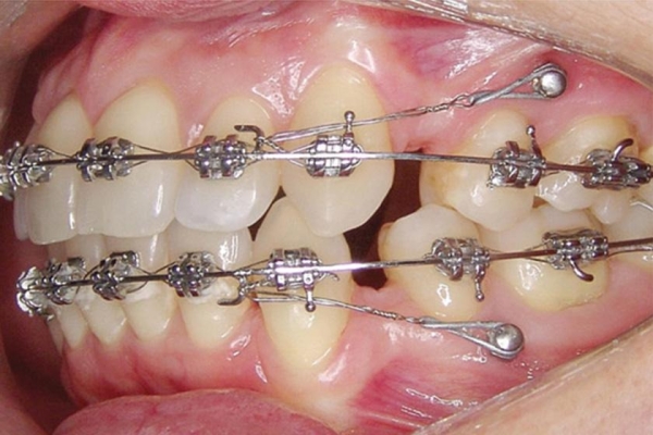 Установка ортодонтических микровинтов