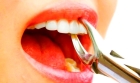 Удаление однокорневого зуба