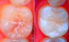 Герметизация фиссур (1 зуб)    